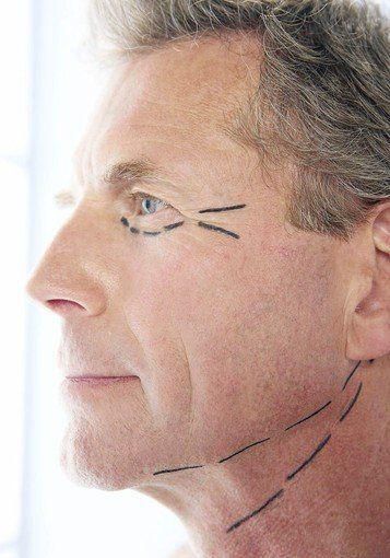 Face lift